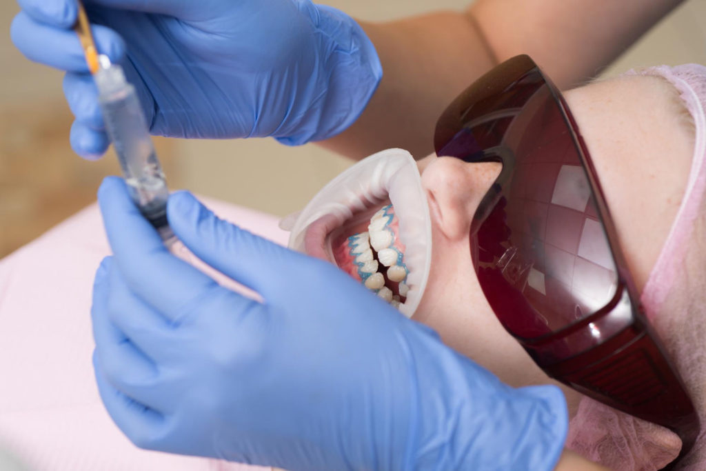 Efekty wybielania zębów mogą być naprawdę spektakularne