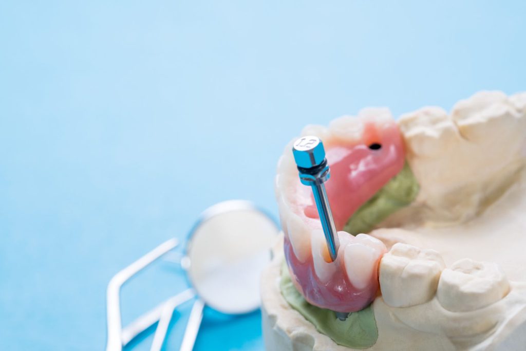 Protetyka implantologiczna to relatywnie nowa dziedzina stomatologii, która zmieniła sposób, w jaki odbudowuje się uzębienie